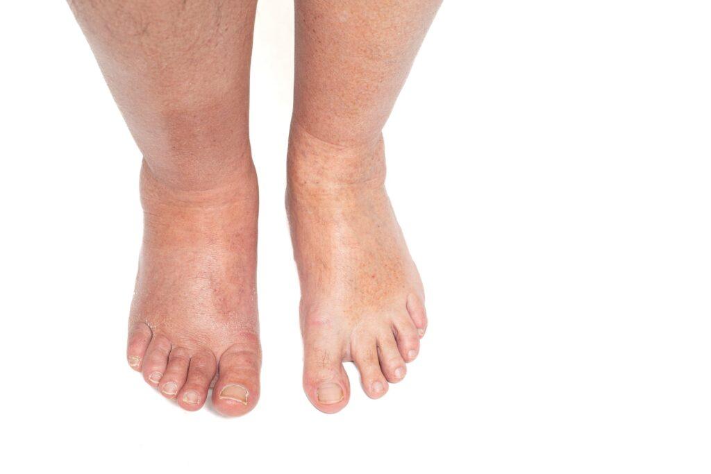 Geschwollene Füsse durch Wassereinlagerung | Lymphdrainage apparativ