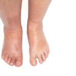 Geschwollene Füsse durch Wassereinlagerung | Lymphdrainage apparativ