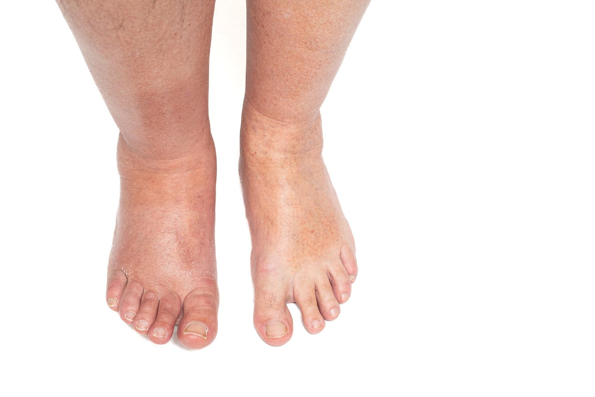 Geschwollene Füsse durch Wassereinlagerung | Lymphdrainage apparativ